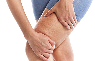 Celulitis